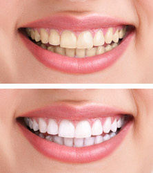 Teeth Whitening provided by Dr. William Carter and Gentle Family Dentistry in Lawton, OK 