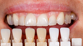Porcelain Veneers provided by Dr. William Carter and Gentle Family Dentistry in Lawton, OK 